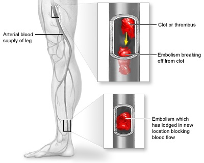 Arterial thromboembolism